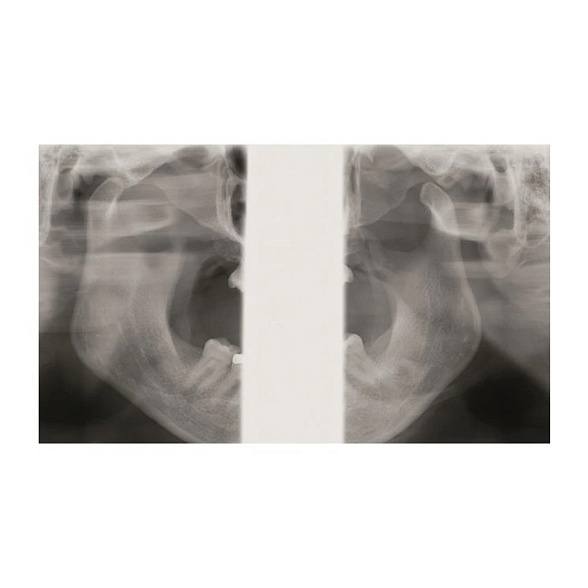 KaVo Pan eXam Plus 3D Ceph (2 датчика) - универсальный датчик Pan/Ceph для панорамной томографии, цефалостат, функция 3D-томографии 6x8 см