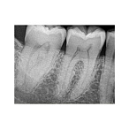 Carestream Dental RVG 6200 - радиовизиограф, 24 пар линий/мм