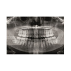 Gendex Pan eXam Plus 2D - дентальный цифровой томограф