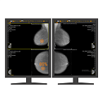 AI-платформа для анализа маммограмм ТриоДМ-МТ