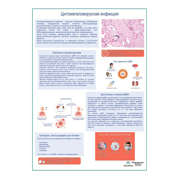 Цитомегаловирусная инфекция, медицинский плакат А1+/A2+ (глянцевая фотобумага от 200 г/кв.м, размер A2+)
