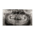 Gendex Pan eXam Plus 2D - дентальный цифровой томограф