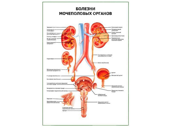 OLD Болезни мочеполовых органов плакат глянцевый А1/А2 (глянцевый A2)