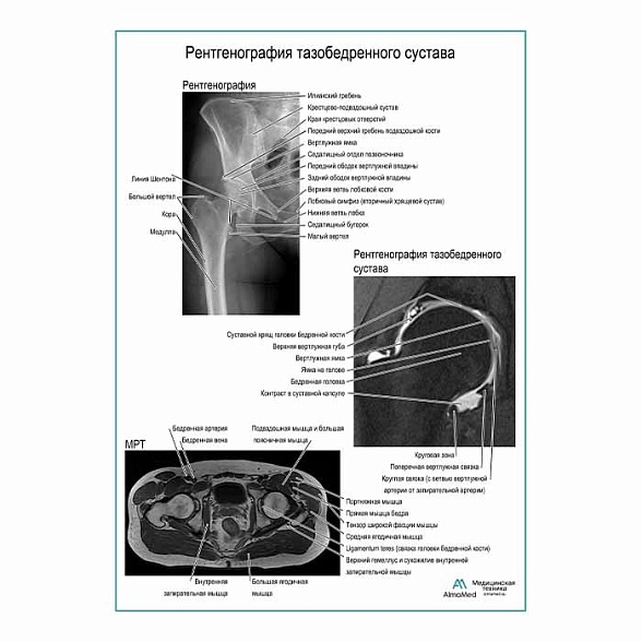 Рентгенография тазобедренного сустава плакат глянцевый А1+/А2+ (глянцевая фотобумага от 200 г/кв.м, размер A2+)