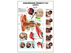 OLD Заболевания среднего уха (отит) плакат глянцевый А1/А2 (глянцевый A2)