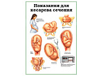 OLD Показания для кесарева сечения, плакат глянцевый А1/А2 (глянцевый A1)