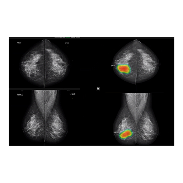 AI-платформа для анализа маммограмм ТриоДМ-МТ
