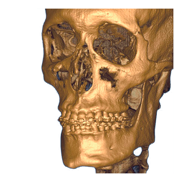 i-CAT 3D eXam / i-CAT - аппарат панорамный рентгеновский стоматологический с функцией томографии
