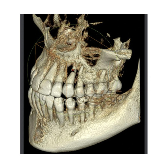 RAYSCAN Symphony Alpha Plus 120 SM3D - ортопантомограф с цефалостатом 26х24 см и компьютерным томографом 3D (4х12)*(3х10) см
